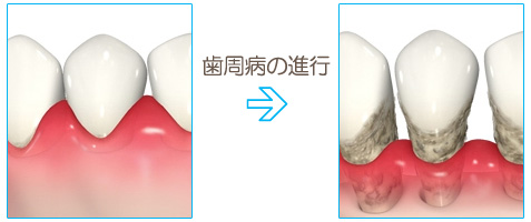 歯周病の進行