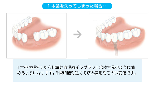 一本歯を失ってしまった場合
