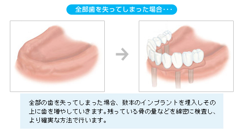 全部歯を失ってしまった場合
