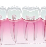 虫歯も早期発見・早期治療